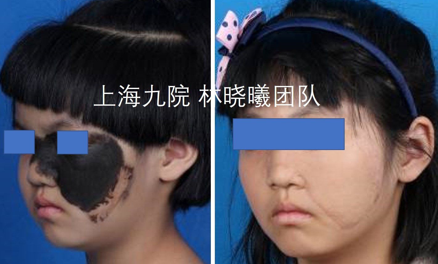 黑色素痣——"痣"关重要的诊疗常识(多图详解)_痣