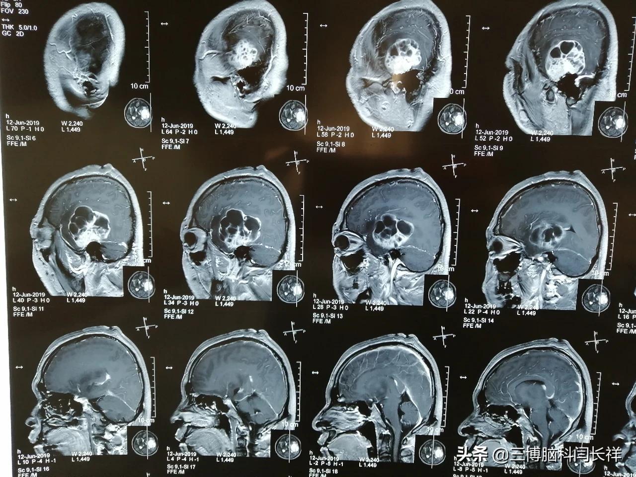 比腦腫瘤更可怕的是冷熱雙重暴力精神焦慮和異常與顱內腫瘤有關