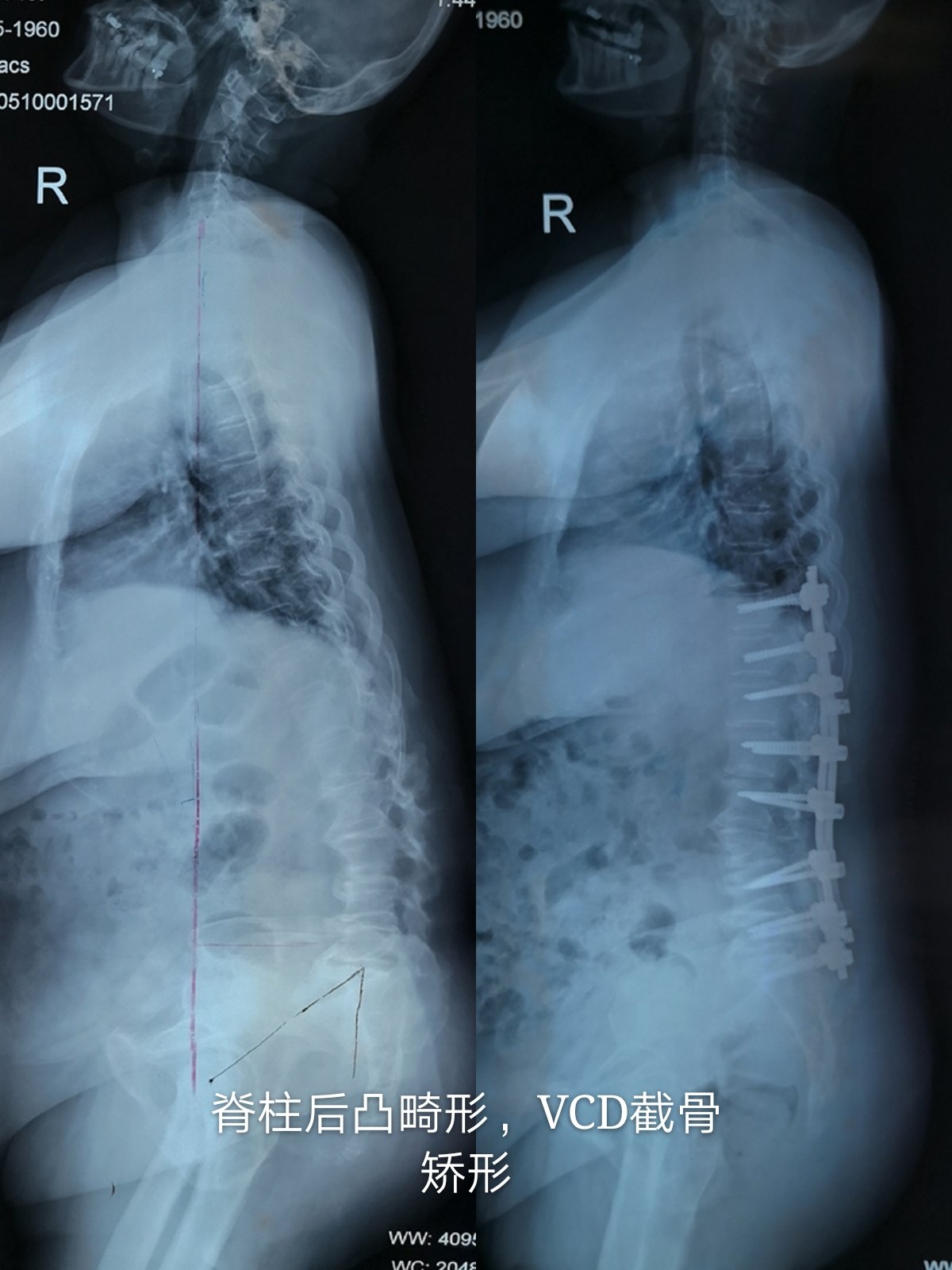 脊柱后凸病人图片