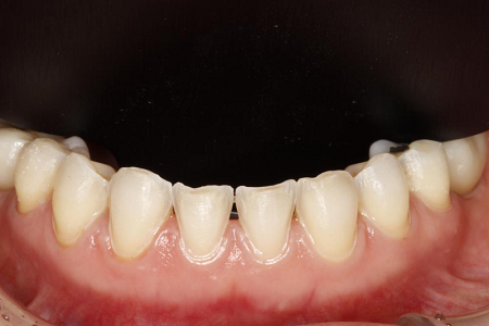 牙齿修复——瓷贴面治疗案例 - 好大夫在线