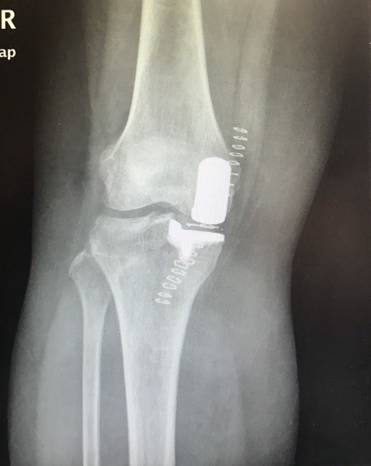 膝骨关节骨刺的治疗方法
