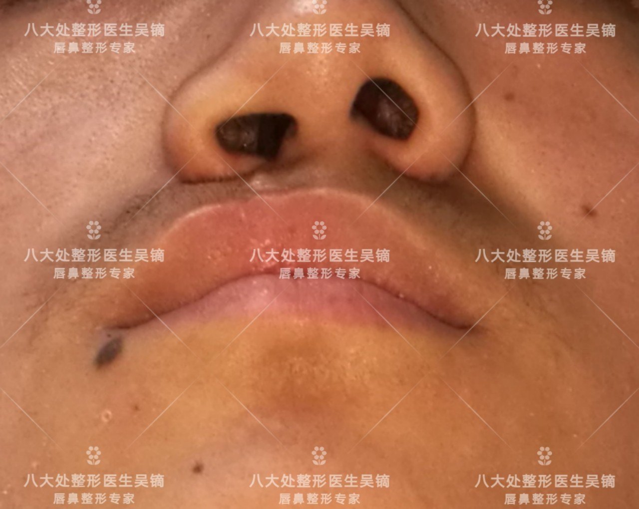 唇裂二期的整形美容修复(多案例分享)_手术 - 好大夫在线