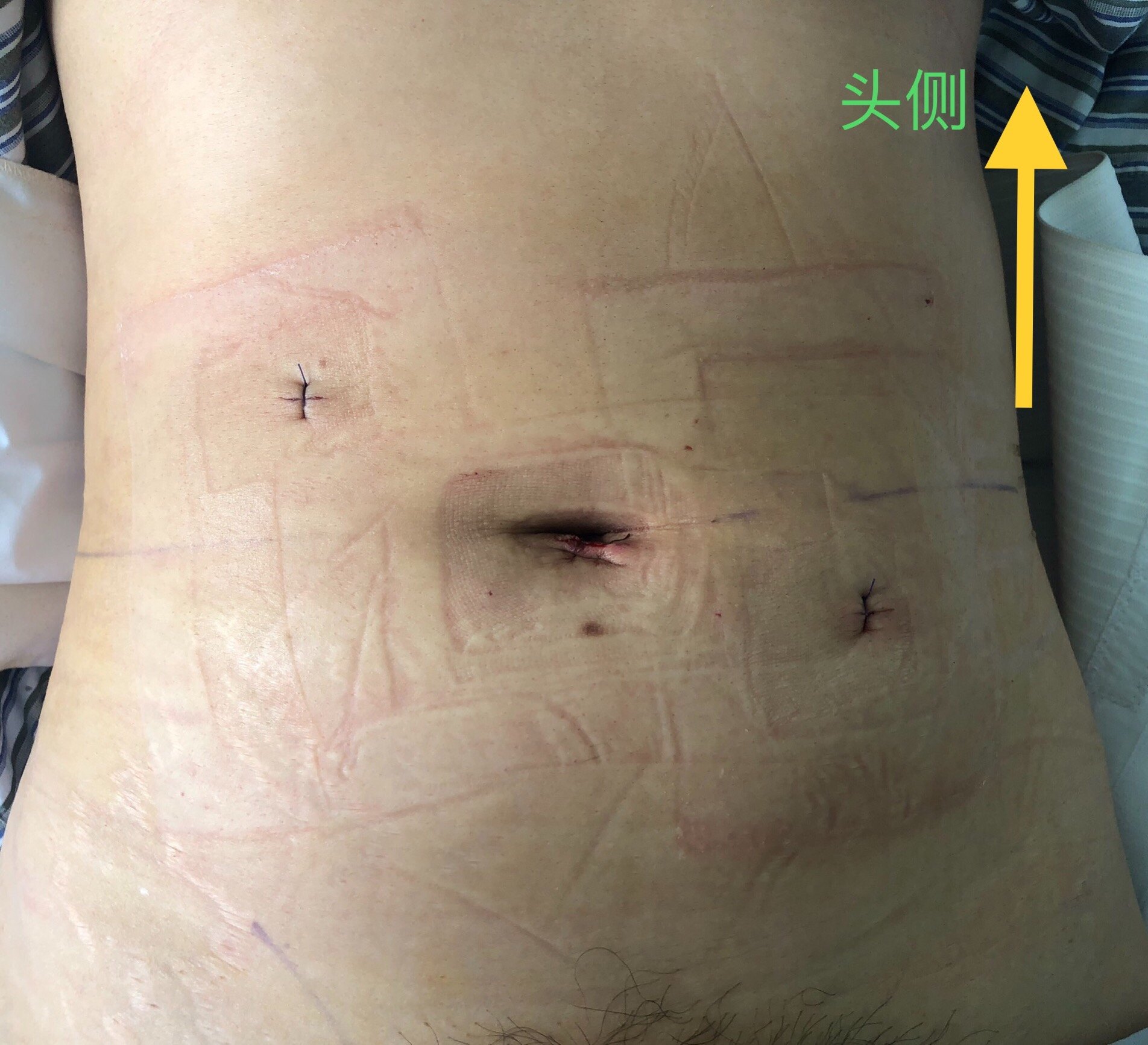 股疝的手术切口示意图图片