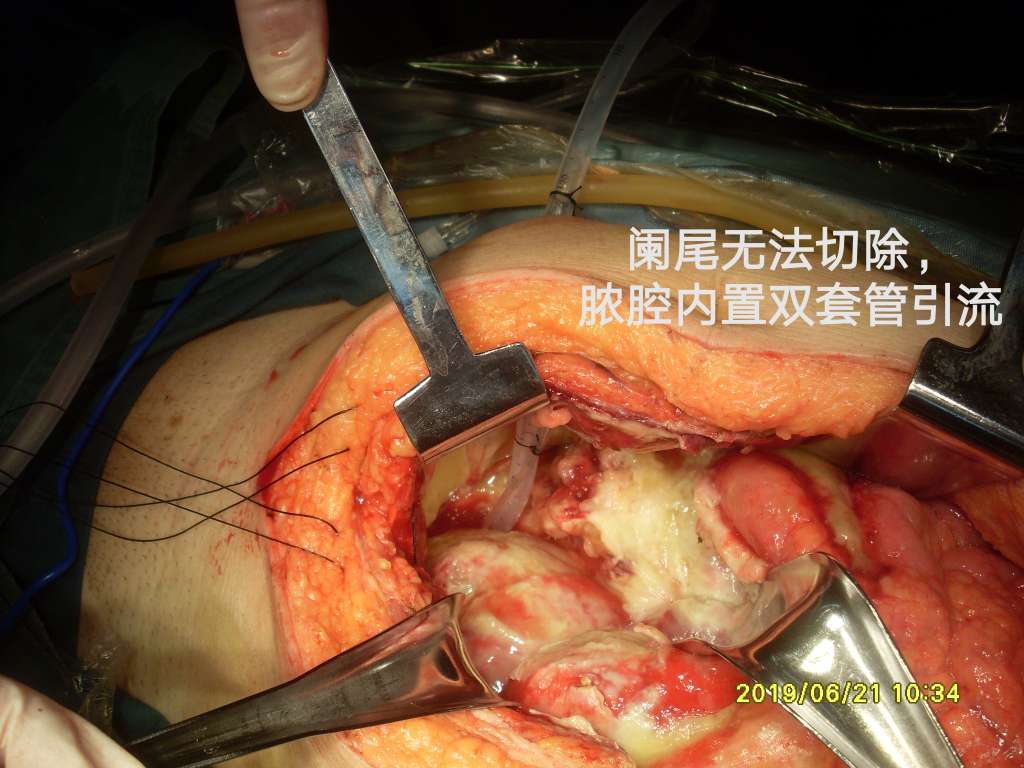 病例82--腹水查因阑尾源性pmp穿孔形成包裹性脓肿 - 好大夫在线