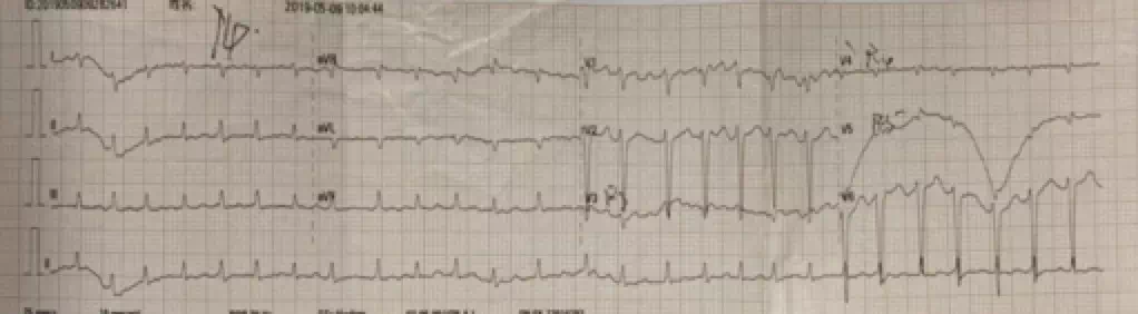 从一个病例学习心律失常性心肌病 心肌病 治疗方法 病因