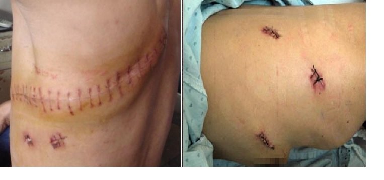 胸腔镜手术后只会在胸壁留下三个较小的疤痕,尤其是单孔胸腔镜术后仅