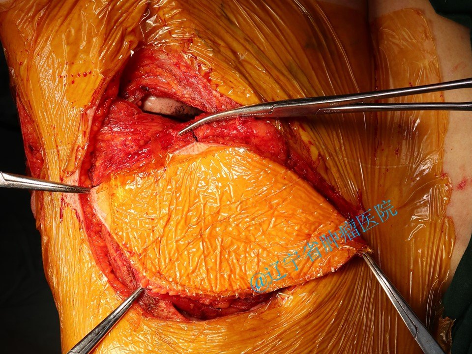 胸壁肋骨软骨肉瘤手术病例分享