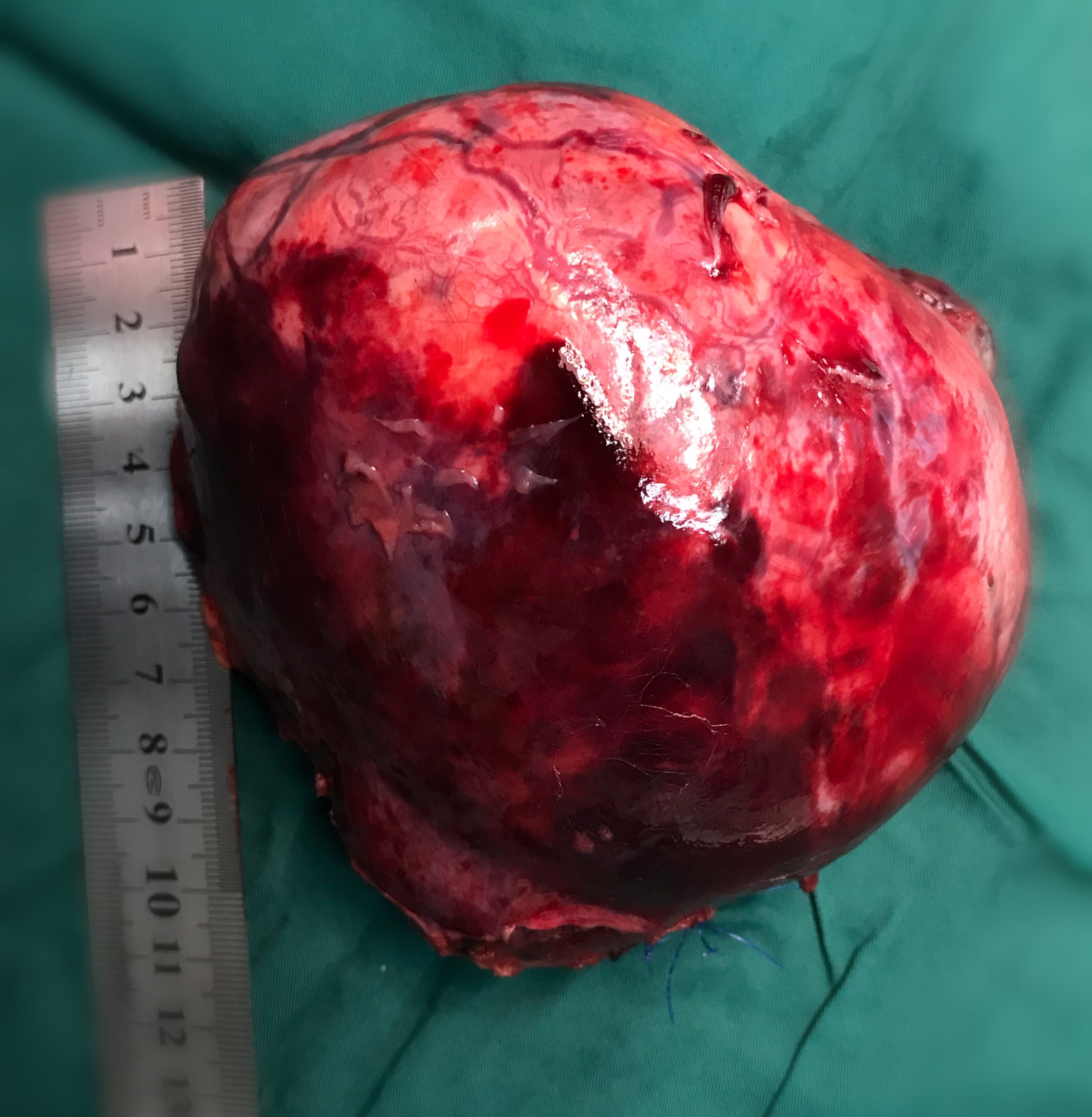 肺癌中期鳞癌是什么意思_肺鳞癌中期平均生存期_中期肺鳞癌能治愈吗