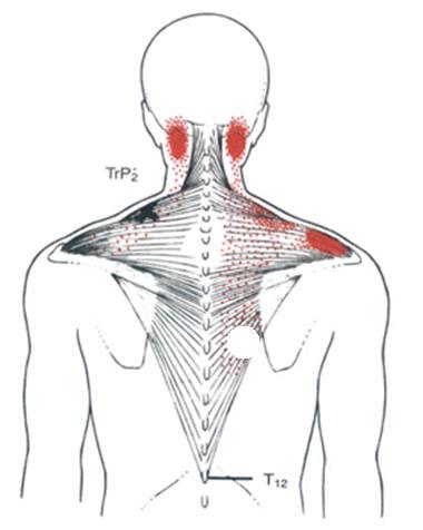 上斜方肌颈背部激痛点