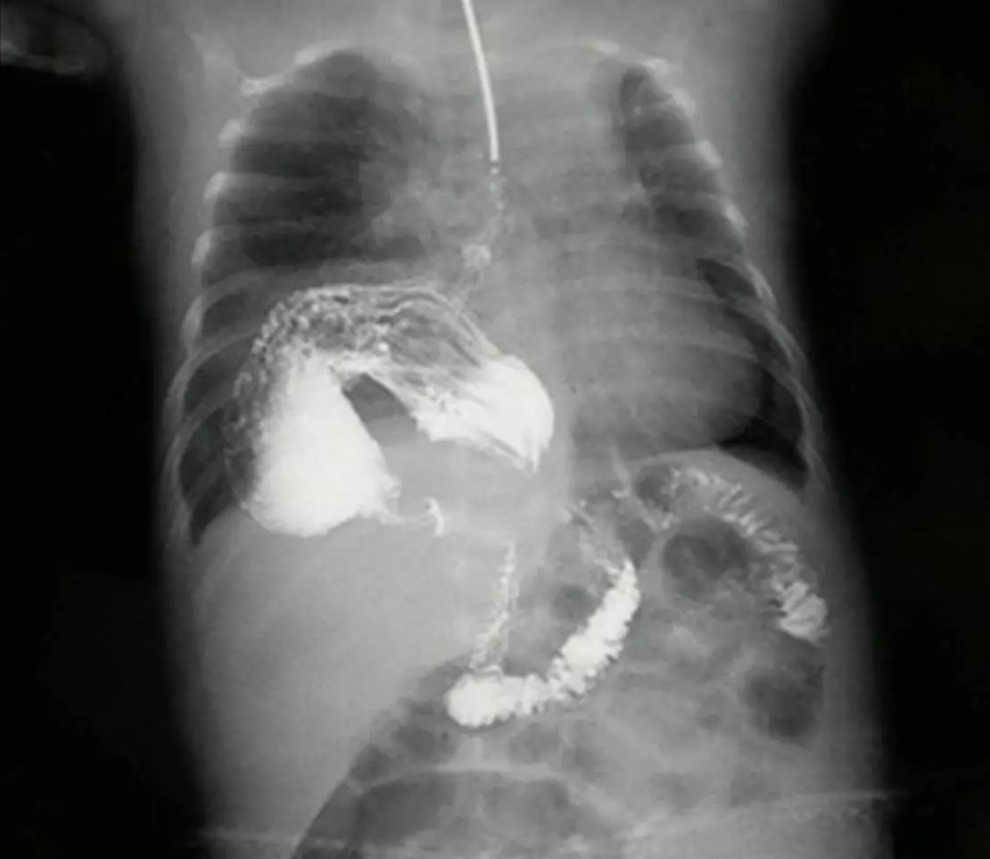 食管裂孔疝ct图片图片