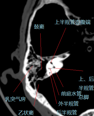 面见上半规管壶腹端,上后半规管总脚及后半规管横断面,可见部分鼓窦区
