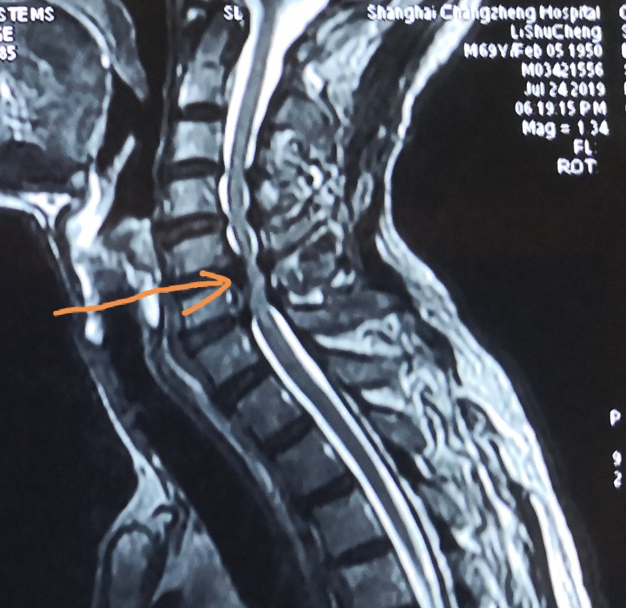 小科普【颈椎后纵韧带骨化症】 - 好大夫在线