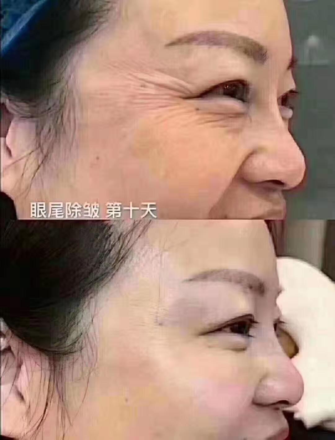 打除皱针脸多久可以热敷(打了除皱针面部僵硬可以热敷吗)