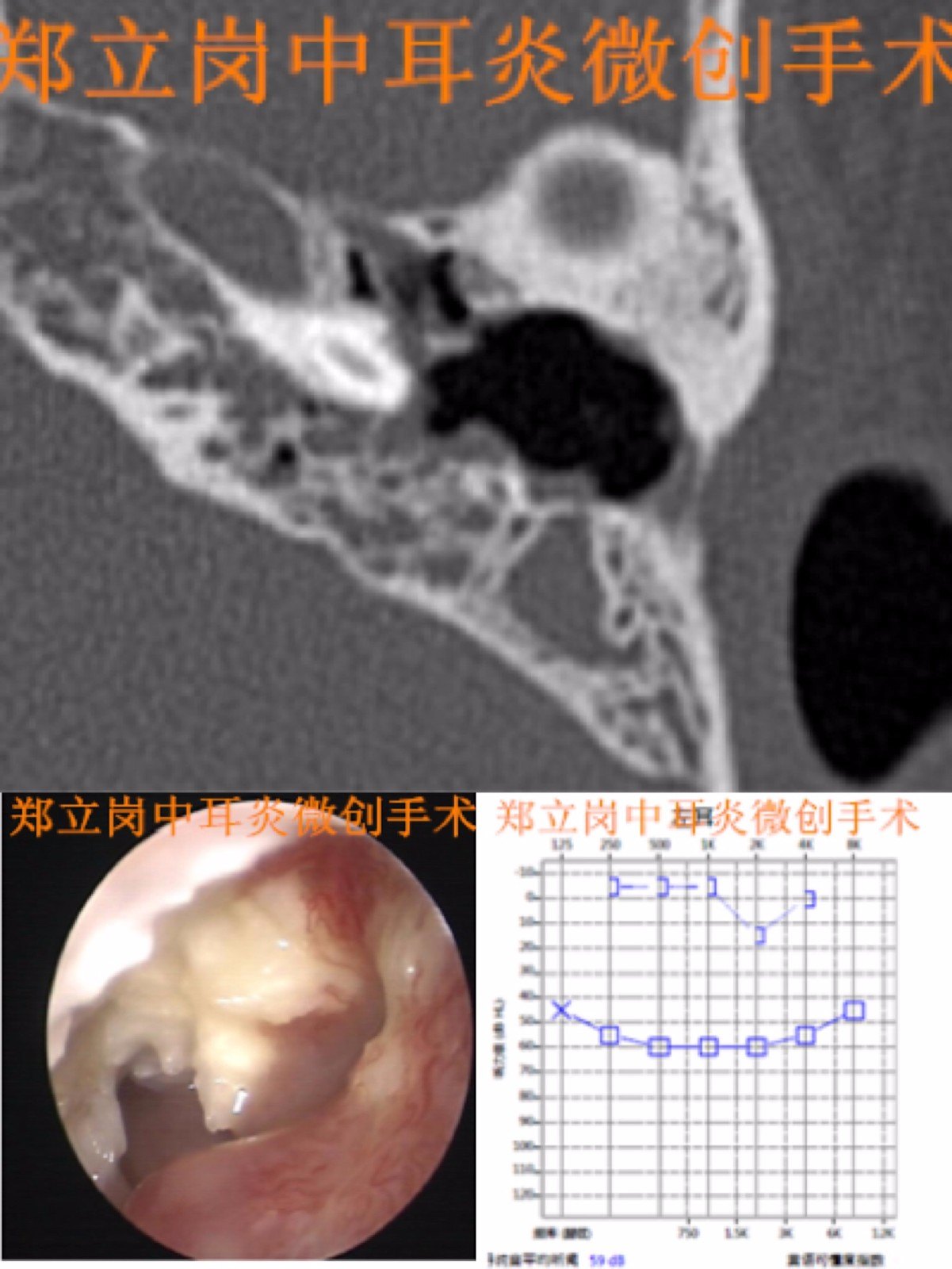 外耳道及中耳膽脂瘤小切口微創手術第923浙江臨海杜橋葛