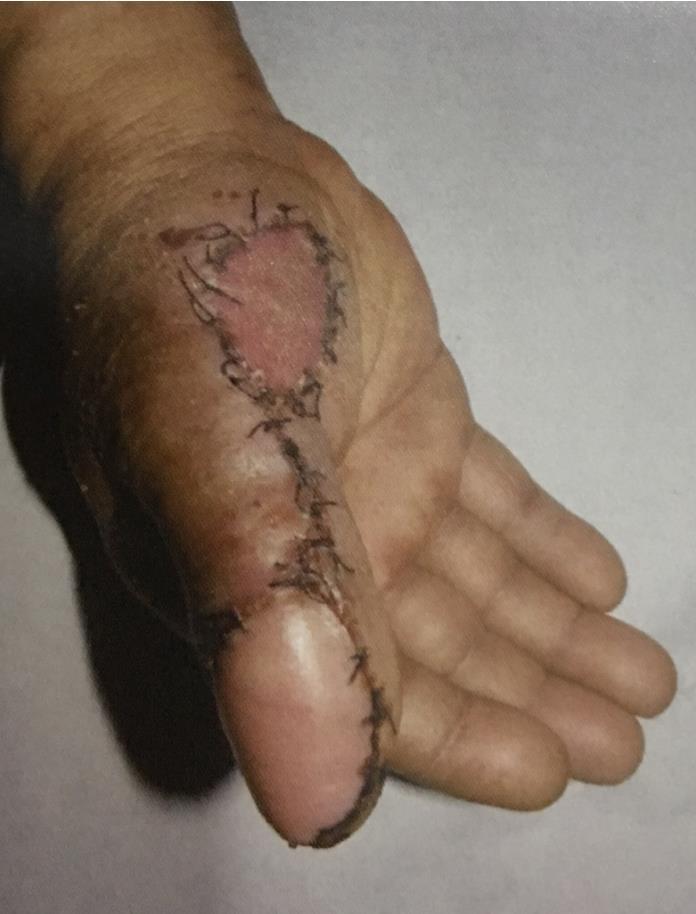 图4手术技巧分析:很多临床的医生在做此类转位皮瓣的时候,经常会出现