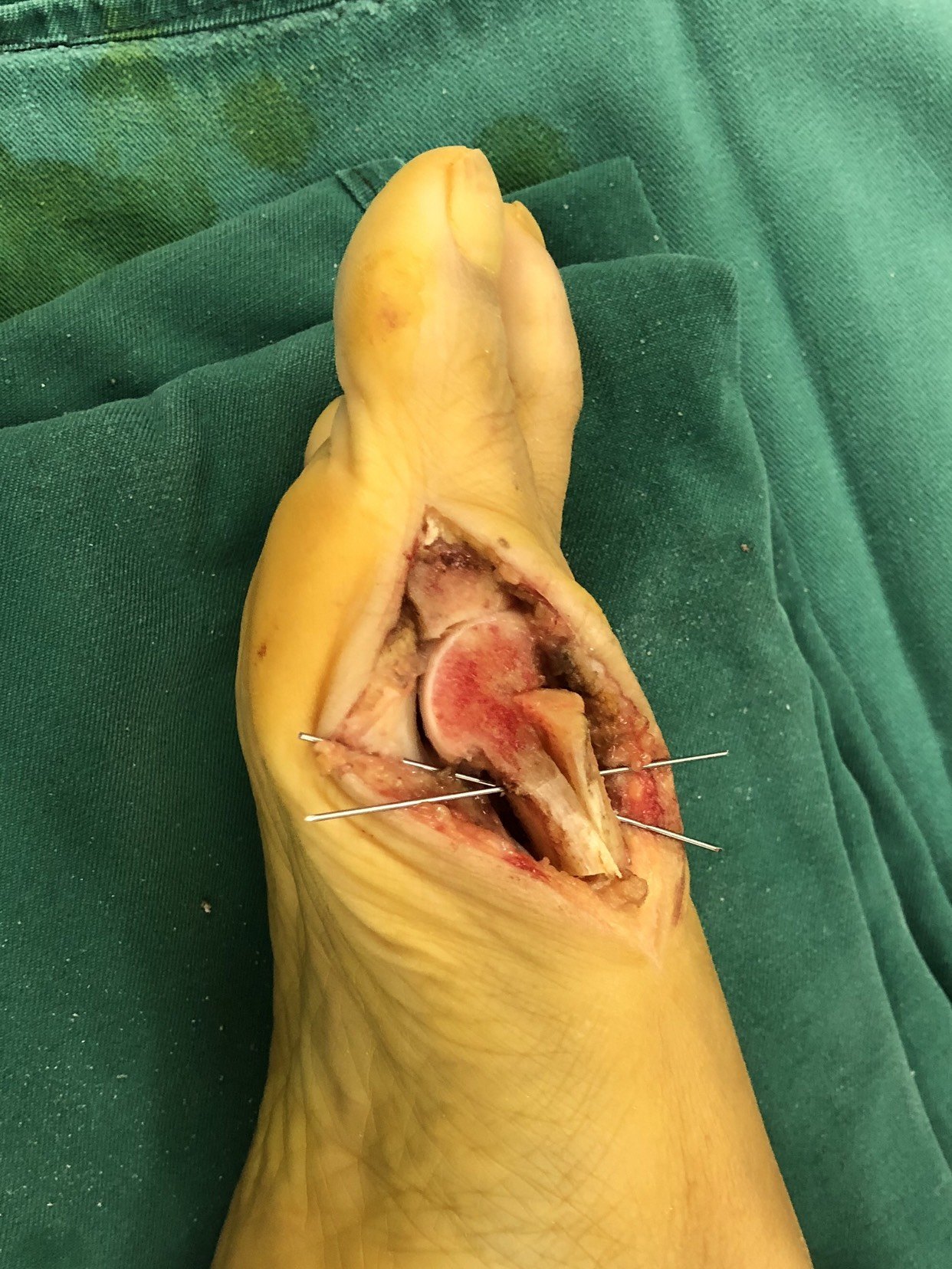 拇外翻病例诊疗分享_拇外翻_拇外翻治疗方式 - 好大夫在线