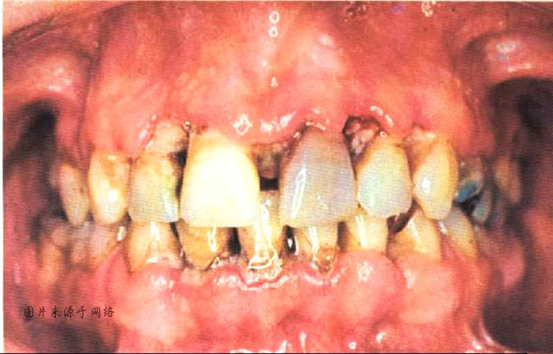 的例子是一种叫做急性坏死性溃疡性龈炎/牙周炎的疾病,表现为牙龈溃疡