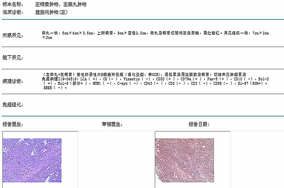 关于阴囊肿块的几点问题 鞘膜积液