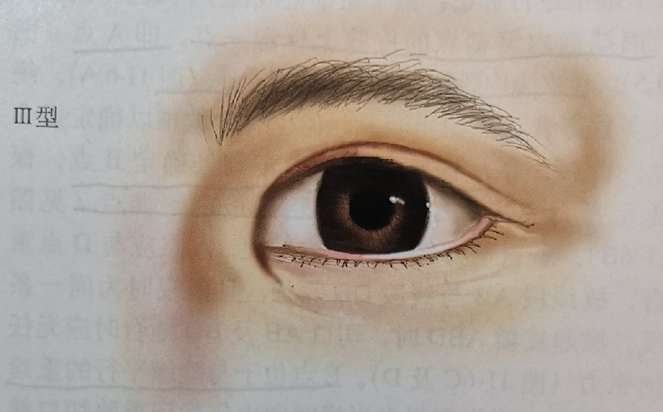 内眦赘皮分型内眦赘皮又称蒙古皱襞,是指通过内眦部的纵向皮肤皱襞,常