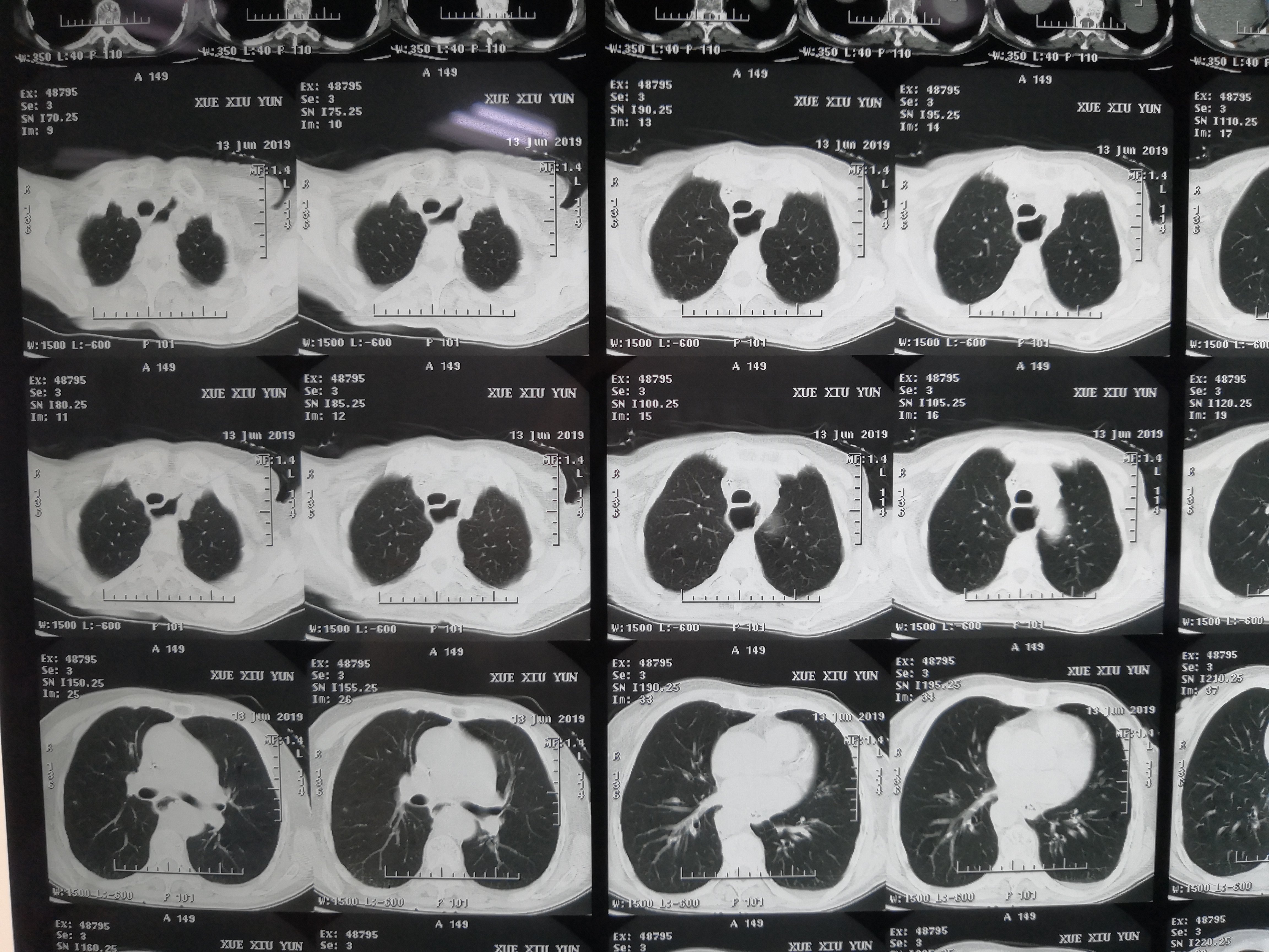 哈医大二院胸外科经典病例之胸腔管状胃 - 好大夫在线