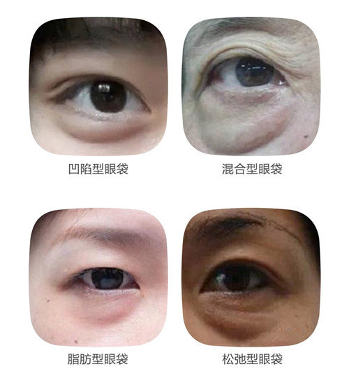 如何去眼袋 去眼袋有哪些手术方法 祛眼袋 泪沟真实案例分享 去眼袋 手术 如何去眼袋 去眼袋有哪些手术方法 祛眼袋 泪沟真实案例分享 去眼袋 手术