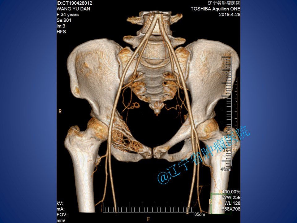 骨盆耻骨肿瘤切除手术病例 - 好大夫在线