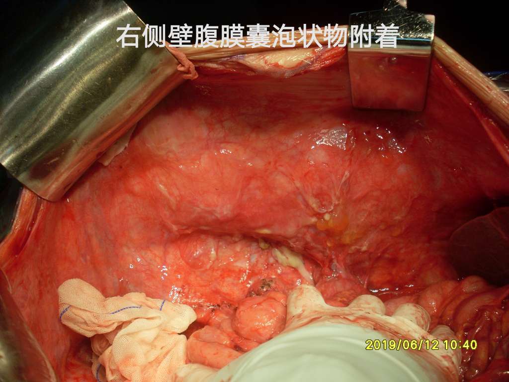 故决定行子宫,双附件,阑尾,大网膜切除 术中一次腹腔热灌注化疗