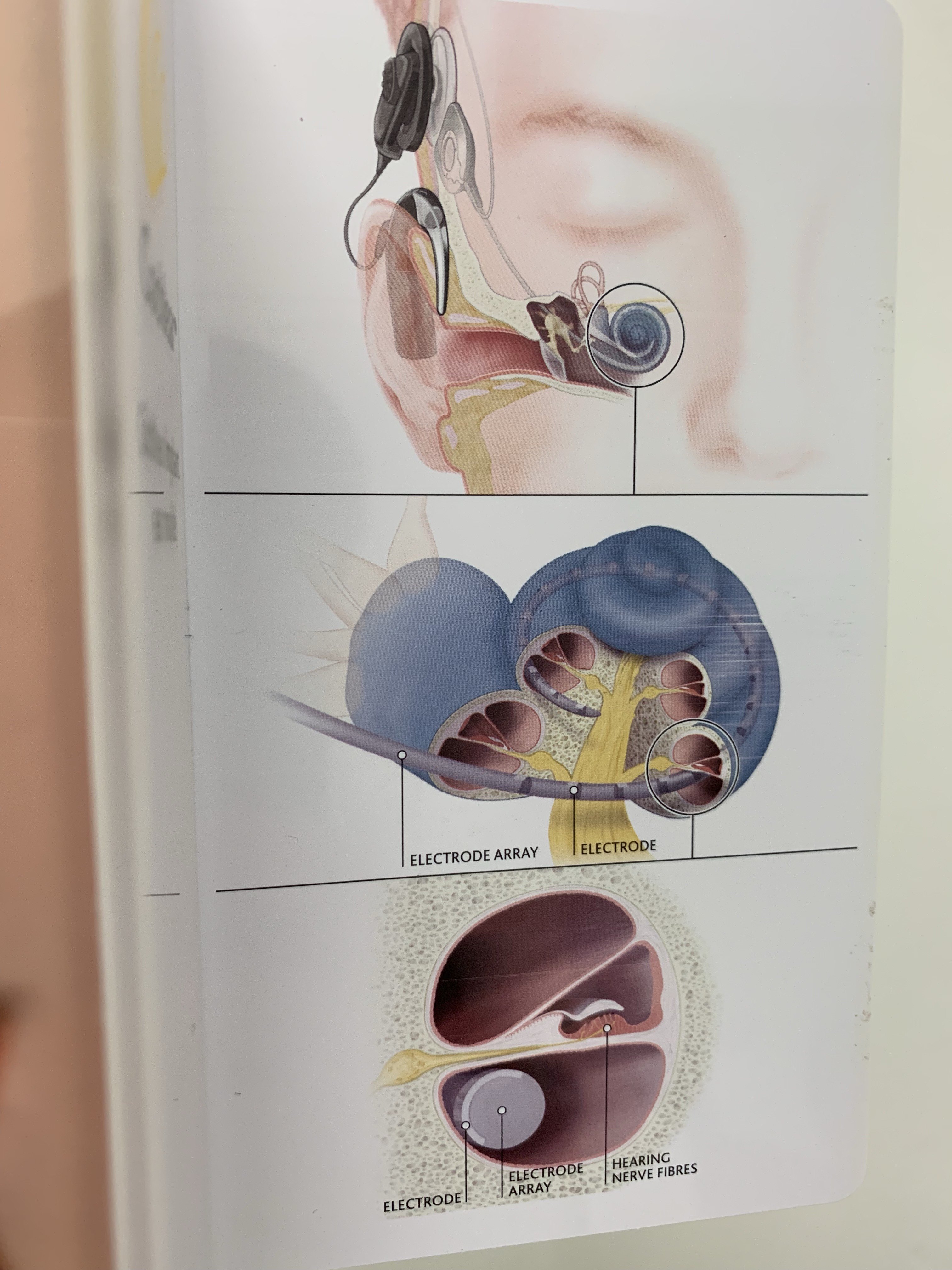 人工耳蜗植入体图片
