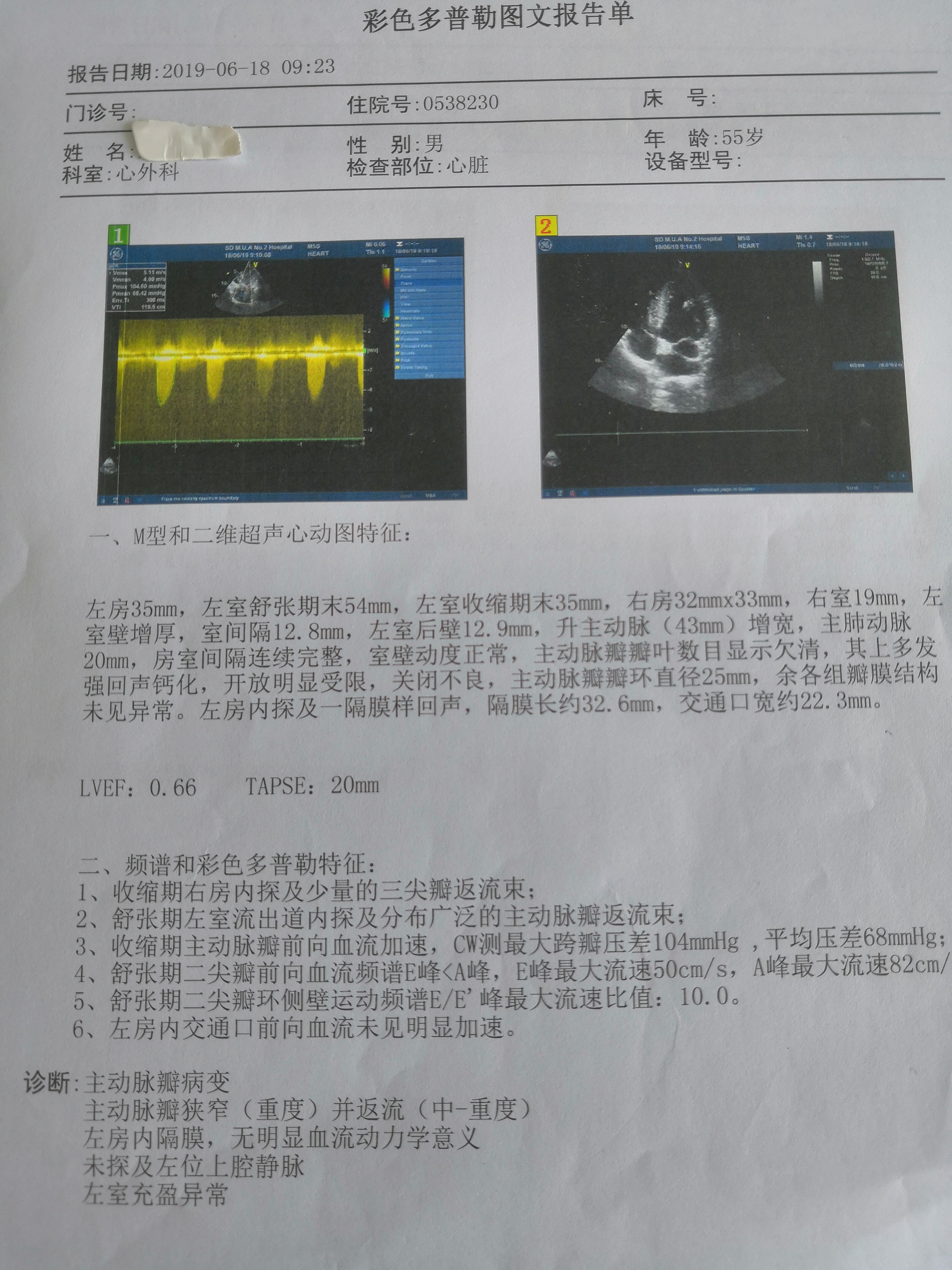 房室瓣钙化图片