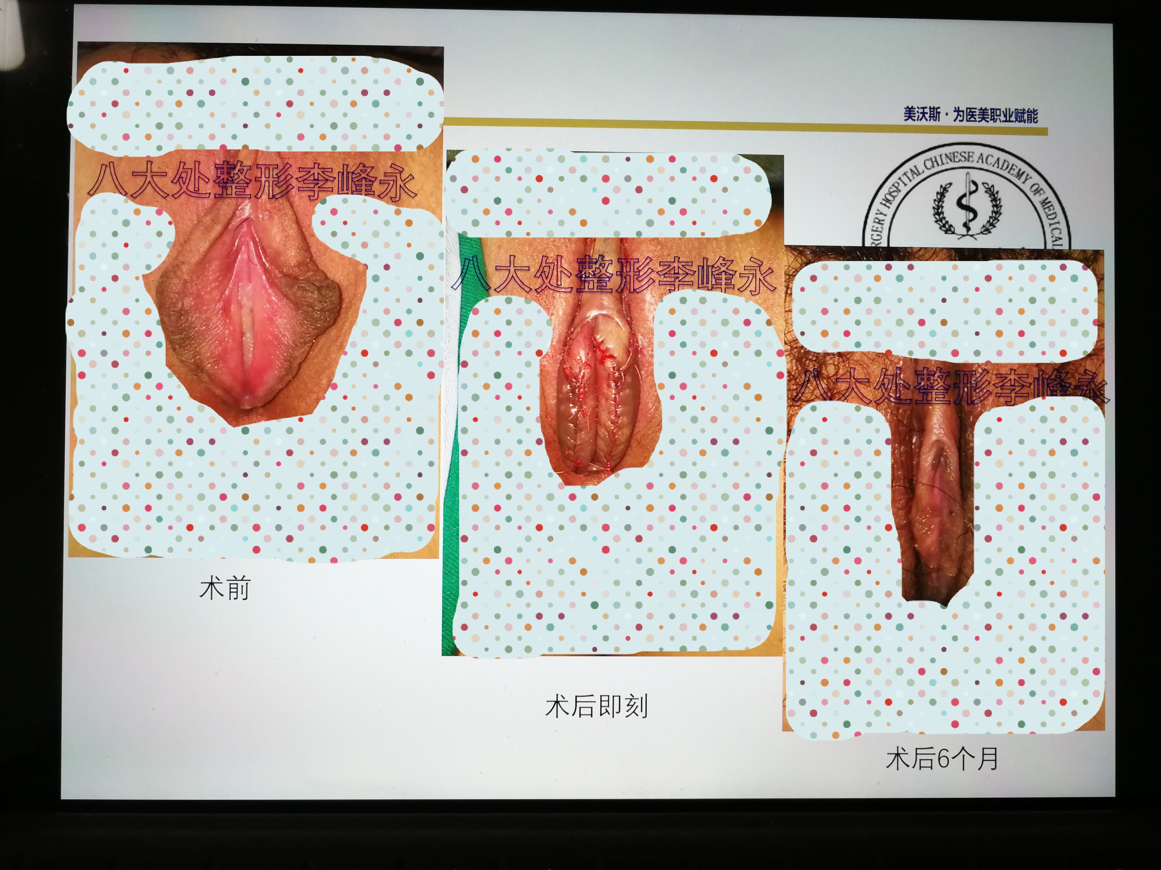 小阴唇 李峰永医生小阴唇手术案例分享（一） - 好大夫在线