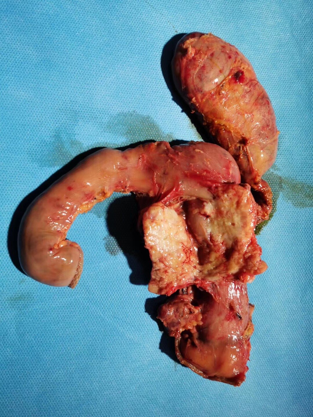 胰头癌血栓图片