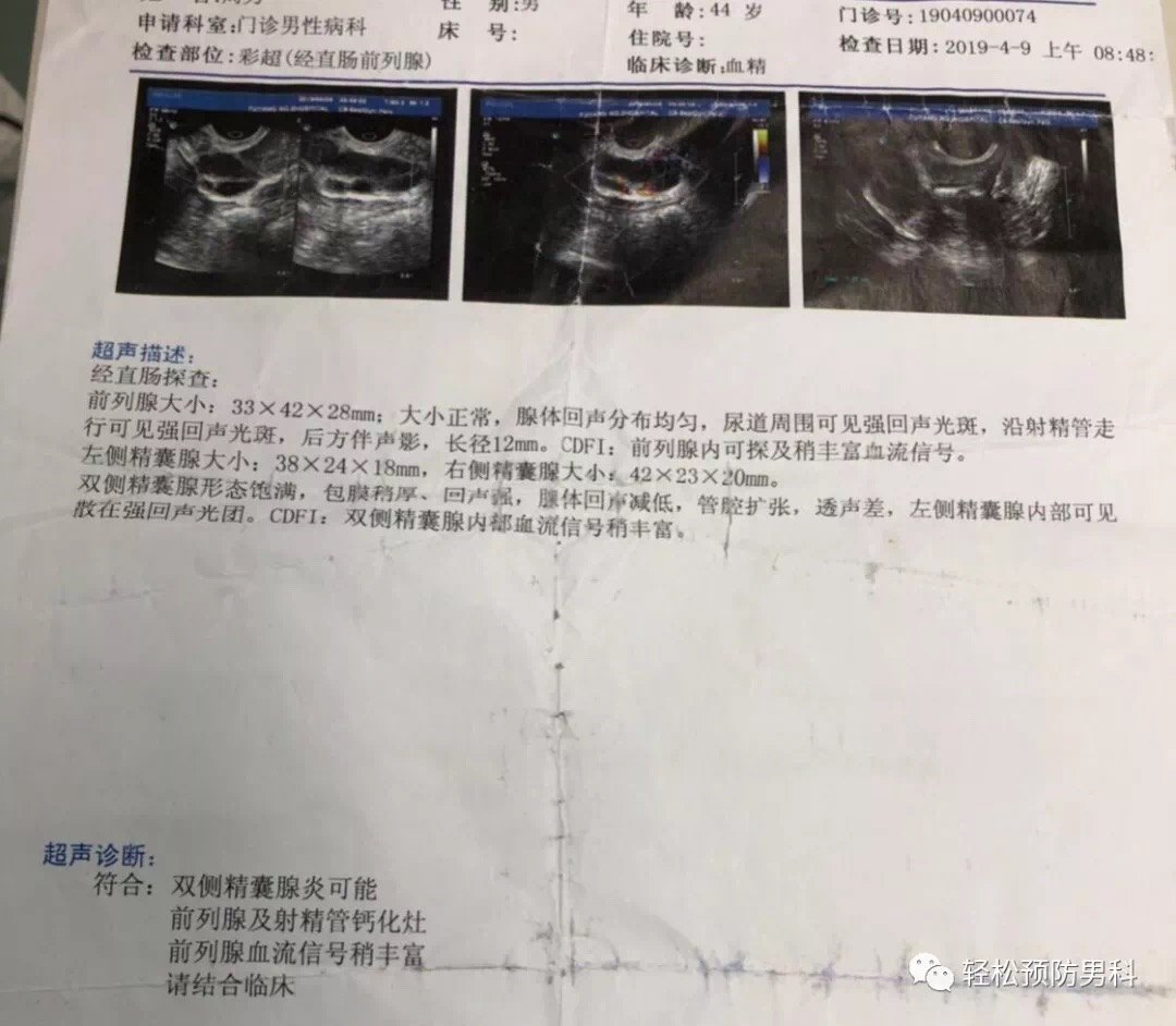 手術工作日誌7怎樣預防血精精囊鏡微創手術治療血精症和精囊結石