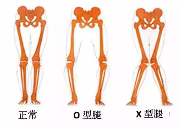 宝宝o型腿是怎么回事?纸尿裤,绑腿会影响宝宝腿型吗?