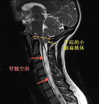 什麼是小腦扁桃體下疝畸形?