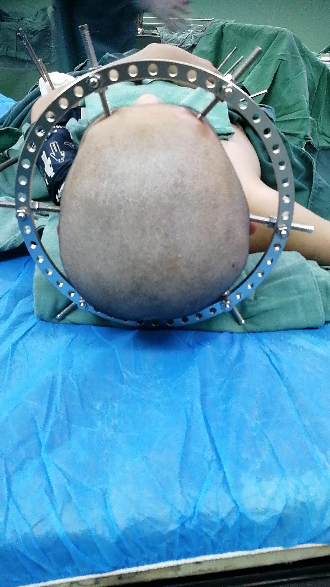 重度脊柱侧弯头盆环外固定牵引时需要有耐心