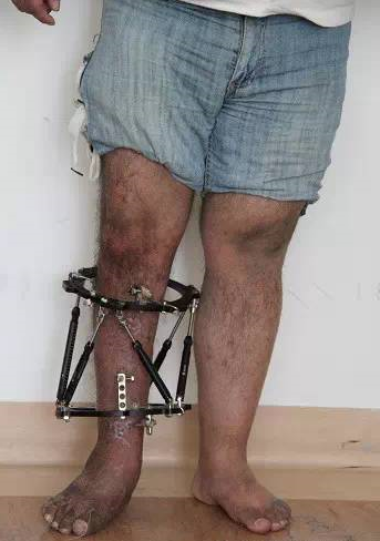 创伤后遗症:泰勒架同步矫正下肢短缩,马蹄内翻 - 好大夫在线