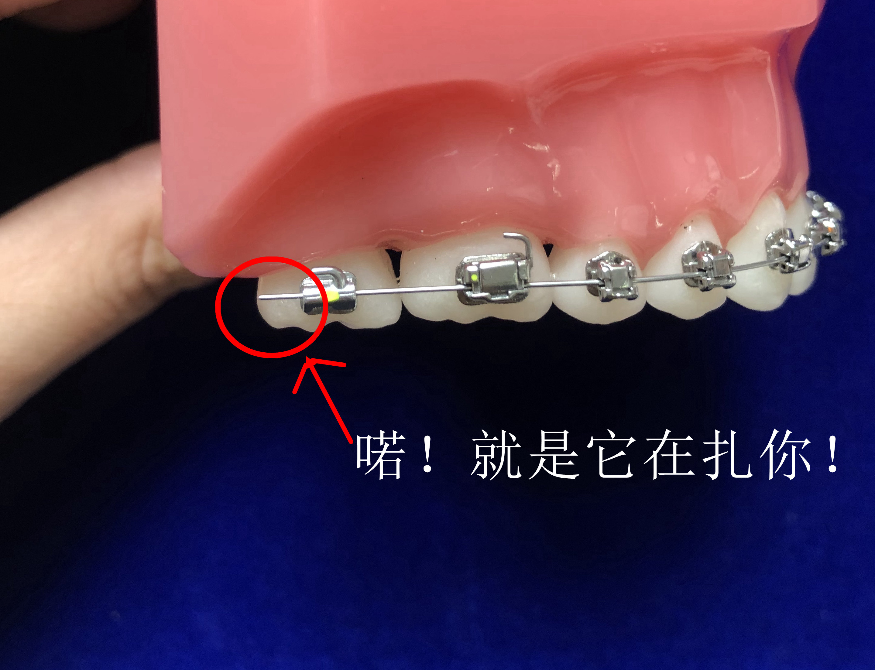 戴牙套后扎嘴怎么办