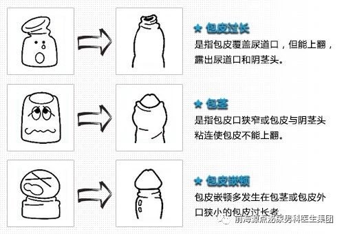 对于包茎患者,一般情况下,7岁以后,如果不能外翻暴露龟头,就要积极