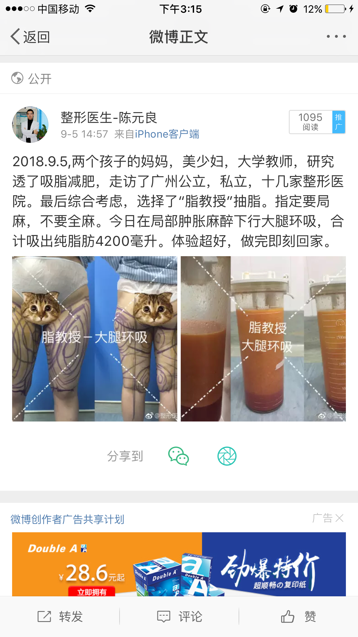 刀鋒論壇吸脂減肥產後肥胖的少婦大腿臀部吸脂實錄顧客原創