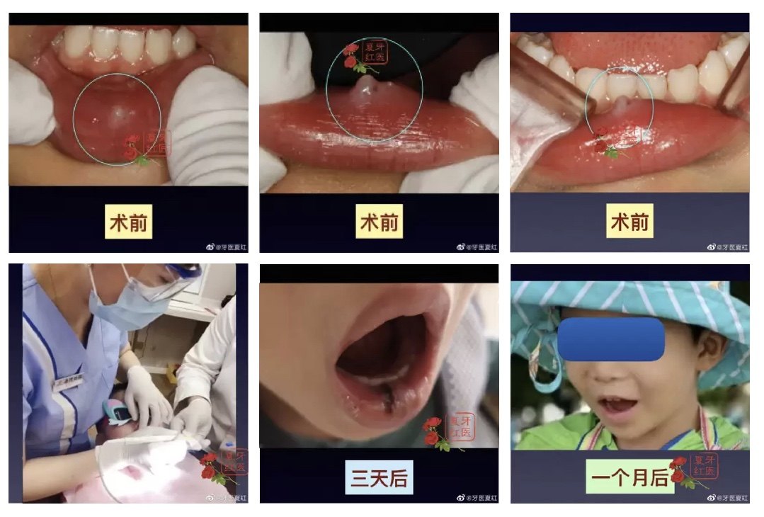 粘液腺囊肿需要手术治疗吗