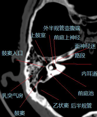 前庭导水管ct解剖图片