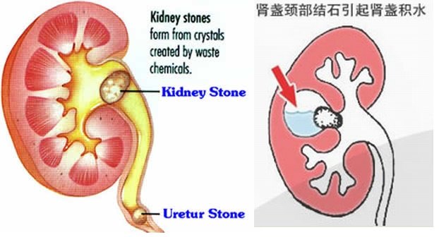 腎盂連接部狹窄腔靜脈後輸尿管輸尿管囊腫等導致腎積水怎麼辦