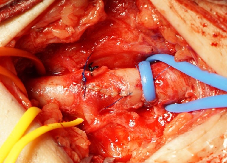 向经典致敬-下肢动脉切开取栓术 - 好大夫在线