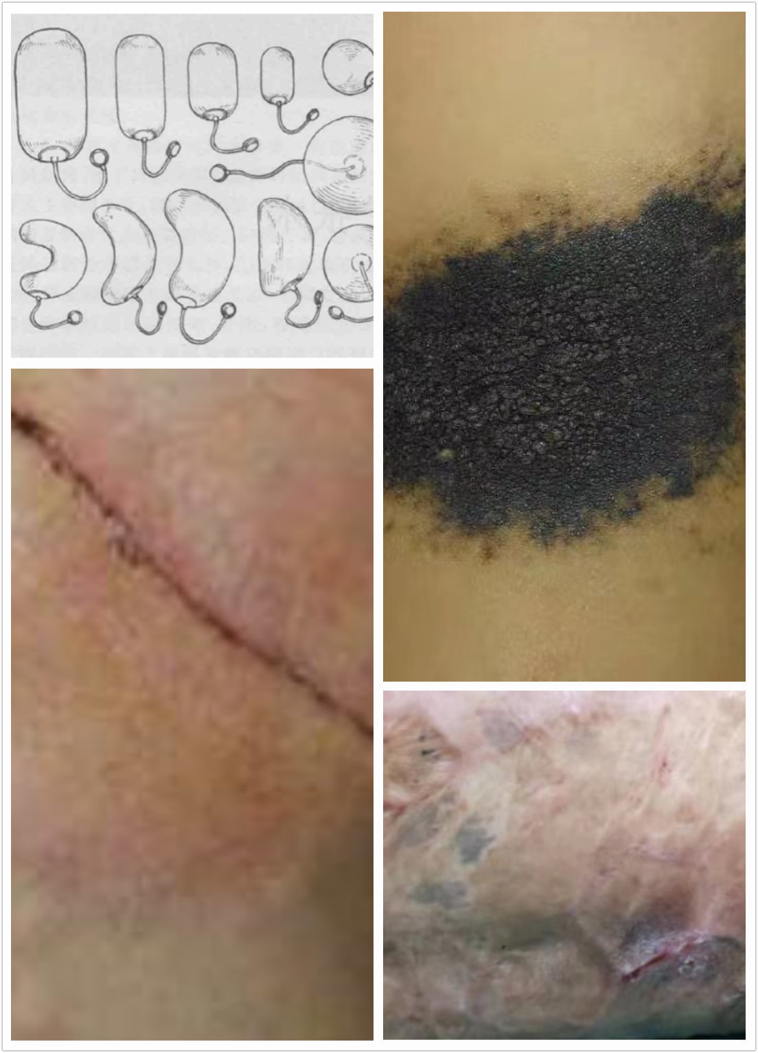 扩张器治疗疤痕图片