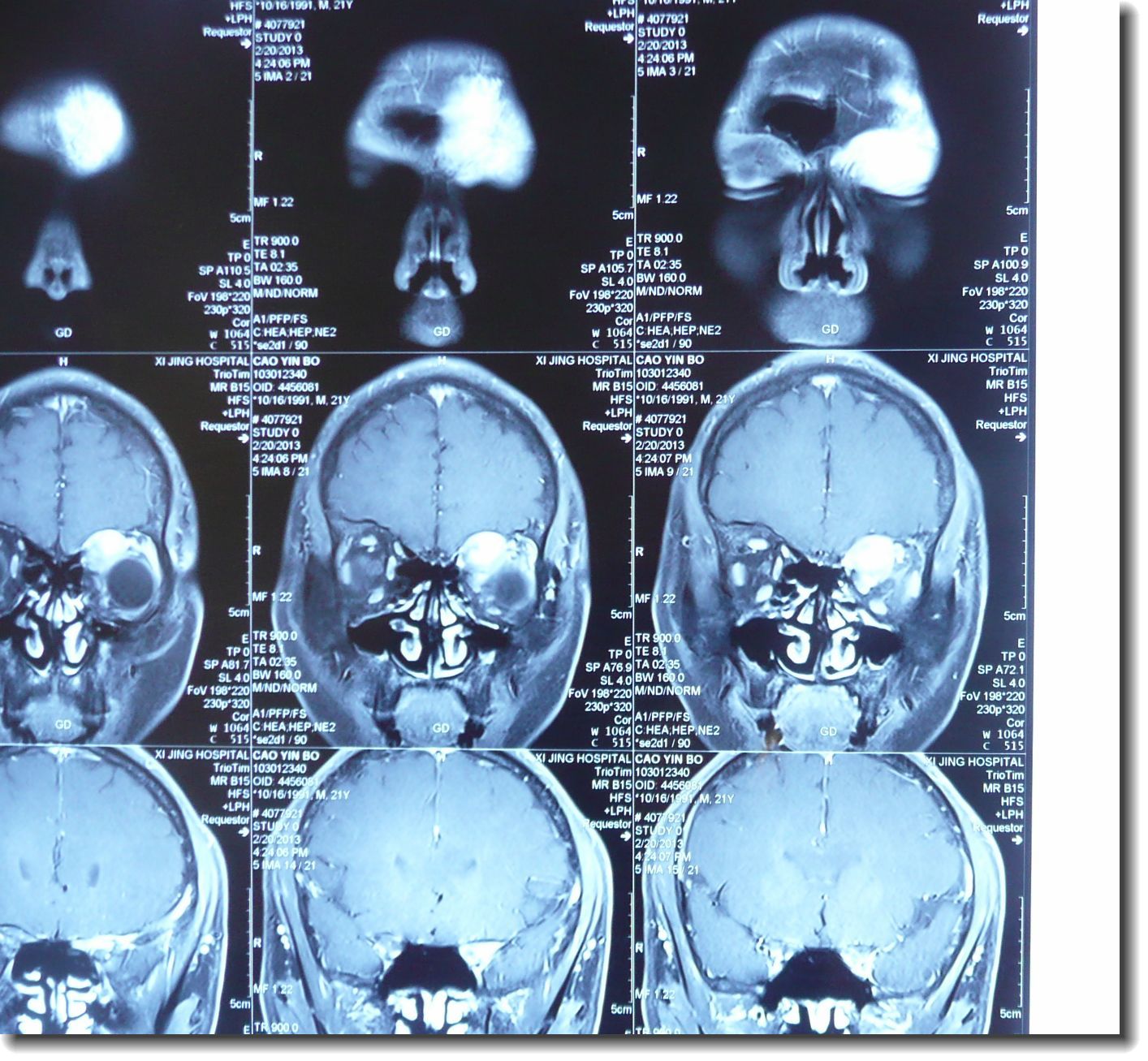 mri:左眼眶内肿瘤(022).