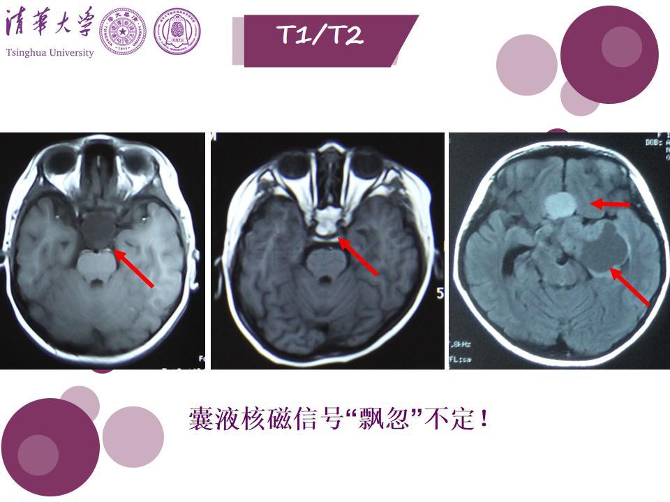 拉克氏囊肿,常与颅咽管瘤相混淆! - 好大夫在线