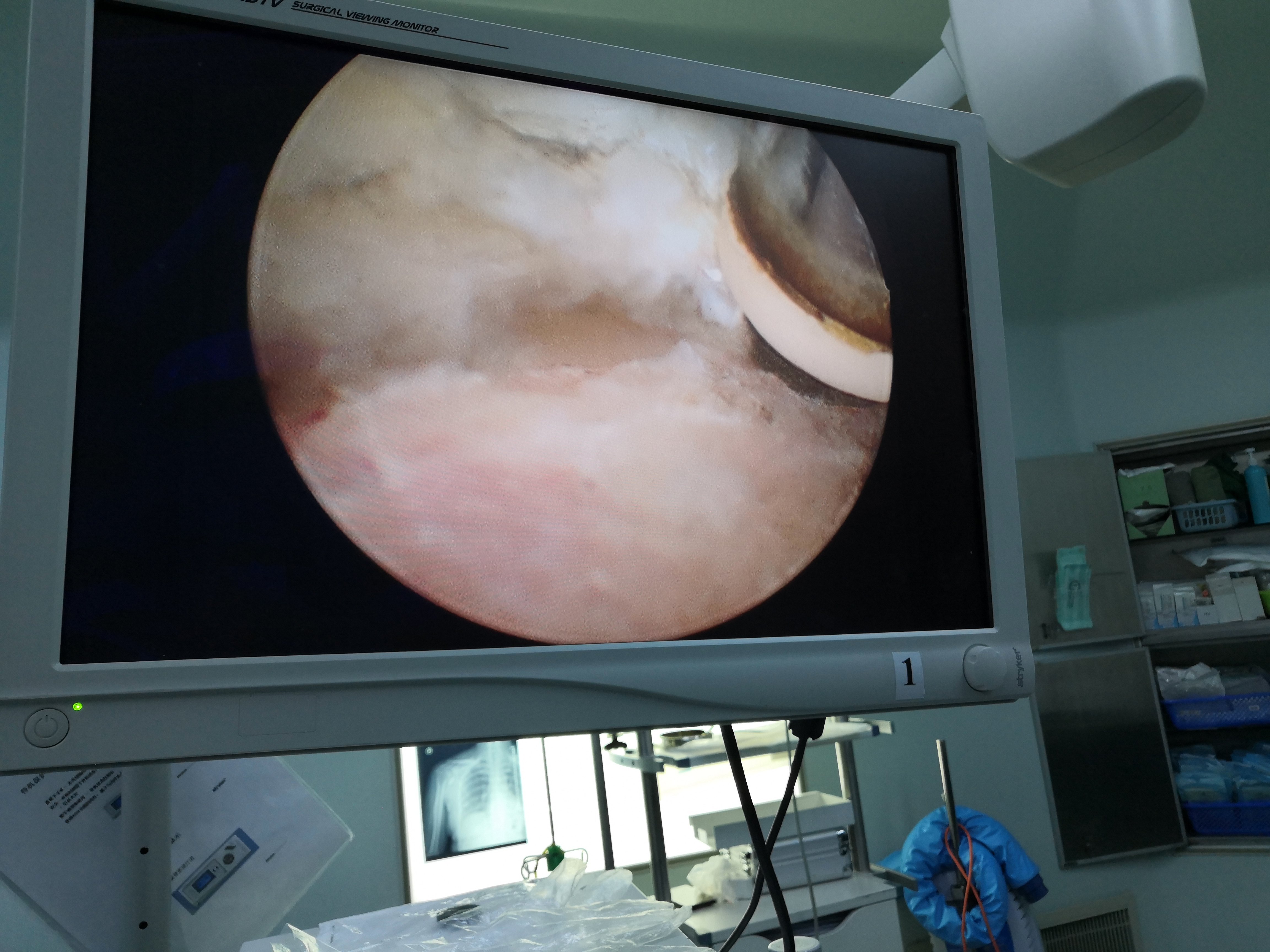 冈上肌腱钙化性肌健炎 - 好大夫在线