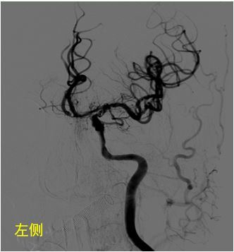 查dsa頭顱mri提示做出頂葉腦梗塞,dsa提示左側頸內動脈,大腦中動脈