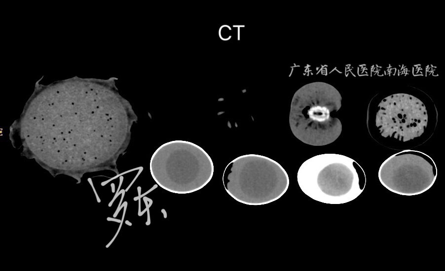 ct好還是mri(磁共振)好?或是x光照片就好?