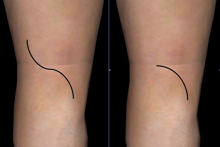 膝关节腘窝处小籽骨图片